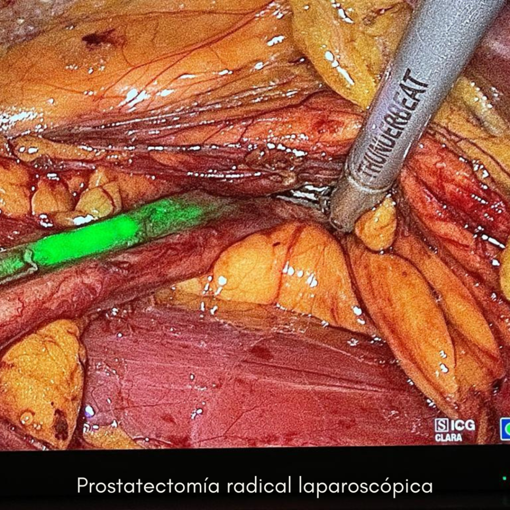 prostatectomia